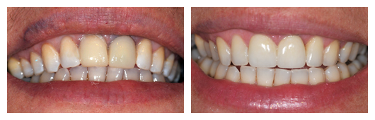 BA_BeataMajnicz_Implant_and_Porcelain _Crowns_on_2_Front_Teeth
