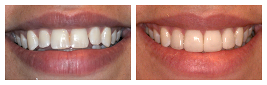 4 Front Veneers 