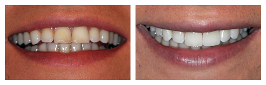 4 Front Veneers 