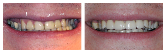 4 Front Veneers