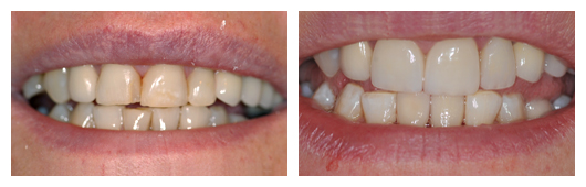 2 Porcelain Crowns and Veneer