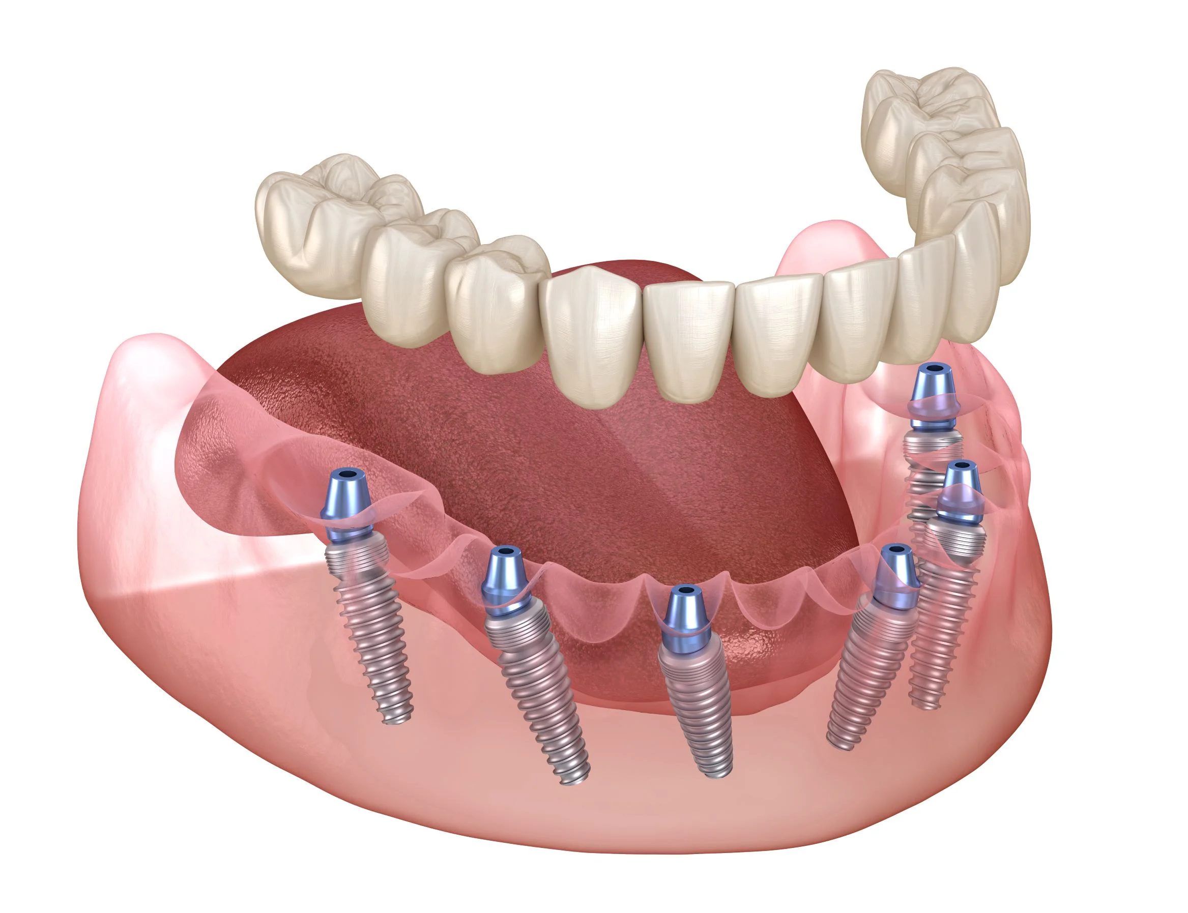 Dental Implants - All-on-X Dental Implants