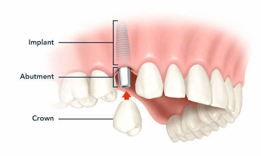 Dental Implant -Single Tooth