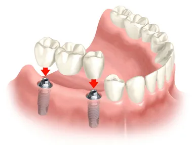 Multiple Teeth