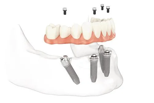 Dental Implants - All-On-Dental Implants