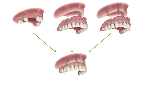 Overdenture Implant Locator Attachments