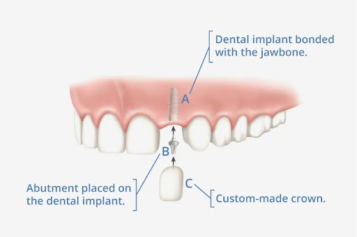 Dental Implants